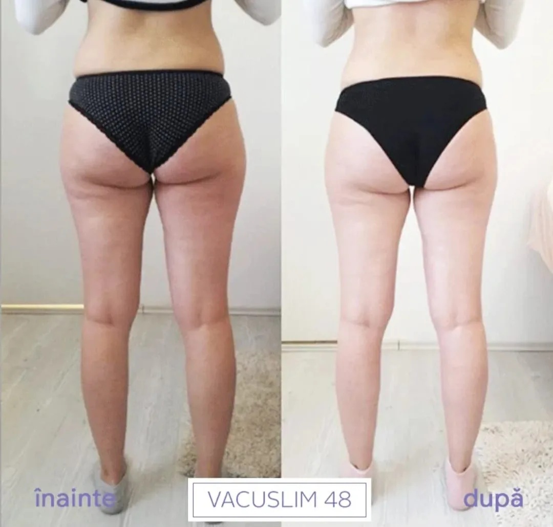 Rezultate Vacuslim 48 Înainte și După 1