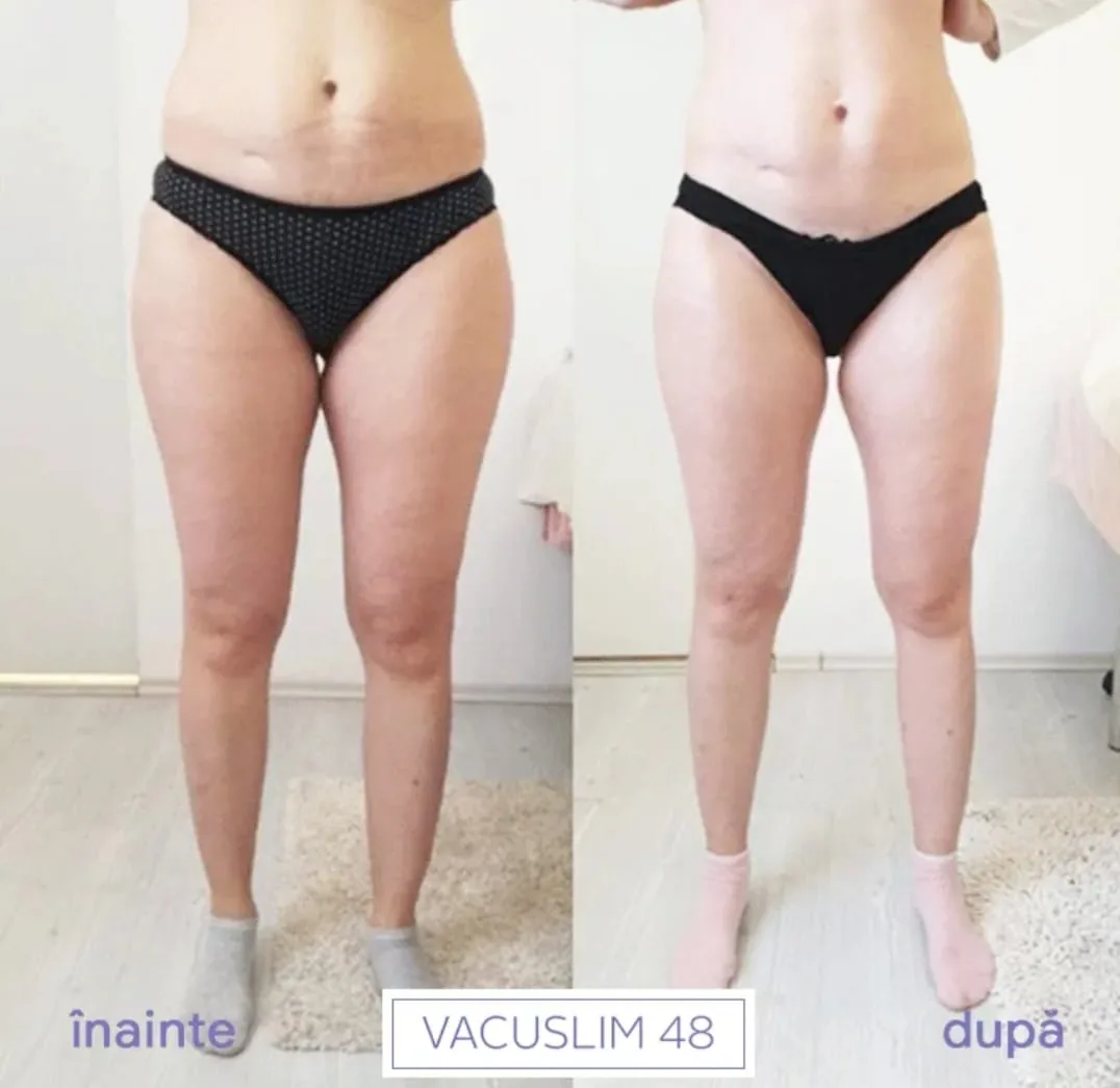 Rezultate Vacuslim 48 Înainte și După 2